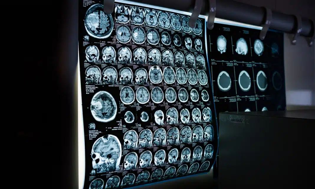 Jak czytać wynik pet-ct?