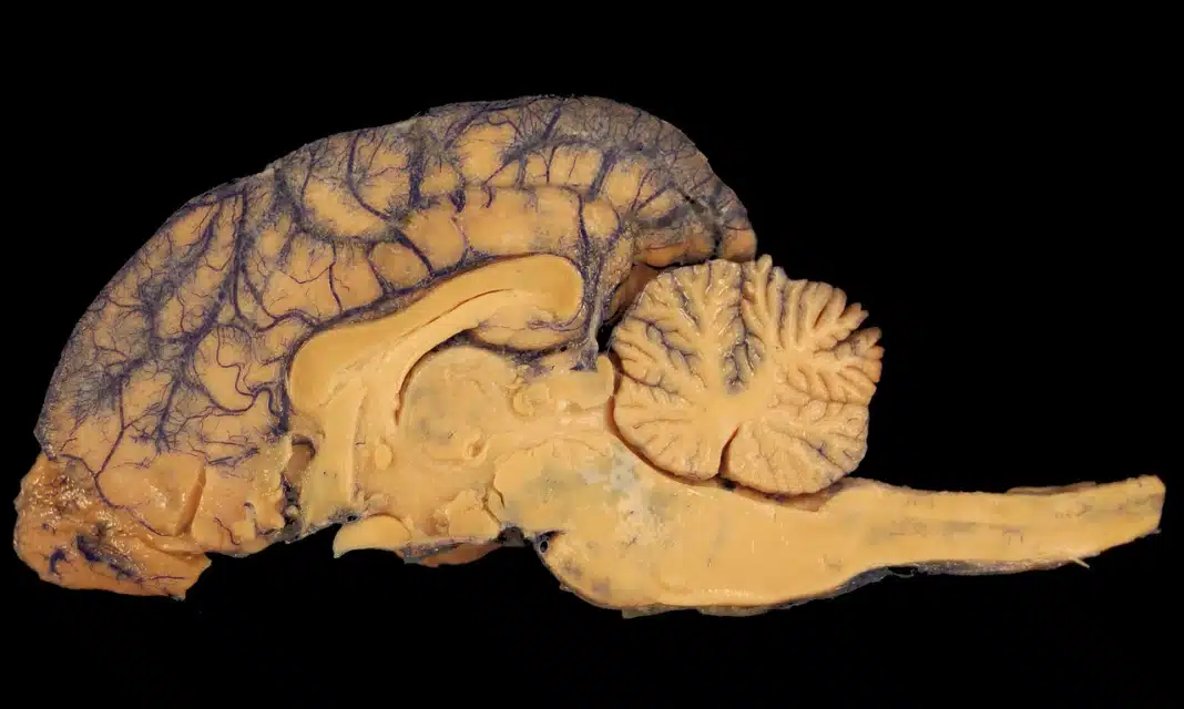 Oponiak mózgu jak szybko rośnie?